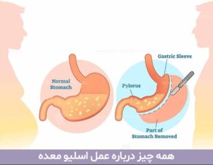 عمل اسلیو معده