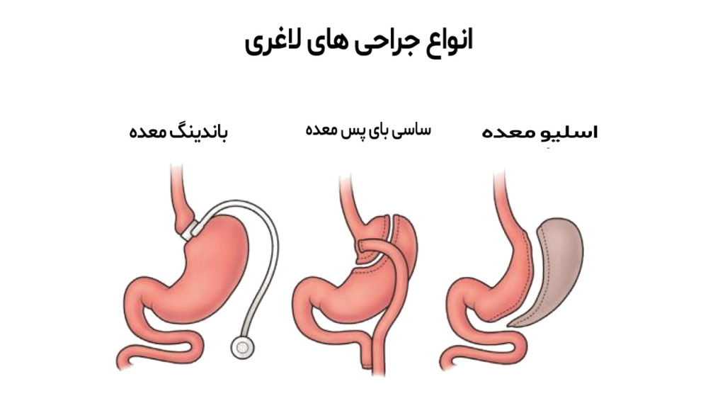 هزینه انواع جراحی های لاغری