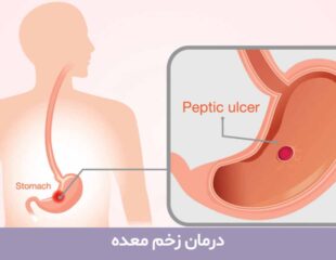درمان زخم معده