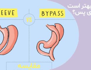 اسلیو بهتر است یا بای پس